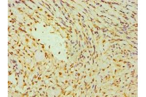 Immunohistochemistry of paraffin-embedded human breast cancer using ABIN7142266 at dilution of 1:100