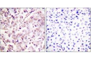 Immunohistochemistry analysis of paraffin-embedded human breast carcinoma, using ETS1 (Phospho-Thr38) Antibody.