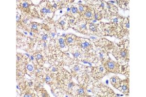 Immunohistochemistry of paraffin-embedded Human liver damage using DLST Polyclonal Antibody at dilution of 1:100 (40x lens).