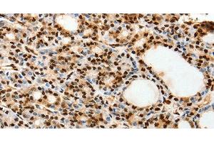 Immunohistochemistry of paraffin-embedded Human thyroid cancer using SPATA20 Polyclonal Antibody at dilution of 1:70