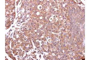 IHC-P Image Mucin 4 antibody detects Mucin 4 protein at cytosol on human breast carcinoma by immunohistochemical analysis.