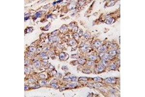 IHC analysis of FFPE human lung carcinoma tissue stained with LAMP1 antibody