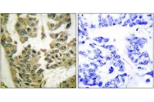 Immunohistochemistry analysis of paraffin-embedded human breast carcinoma, using GRF-1 (Phospho-Tyr1105) Antibody.