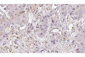 ABIN6273950 at 1/100 staining Human liver cancer tissue by IHC-P.