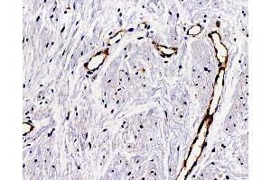Immunohistochemistry analysis of paraffin-embedded Human hysteromyoma using VWF Polyclonal Antibody at dilution of 1:300.