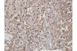 IHC-P Image Immunohistochemical analysis of paraffin-embedded human lung cancer, using DOCK 180 , antibody at 1:100 dilution.