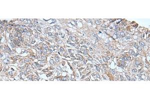 Immunohistochemistry of paraffin-embedded Human lung cancer tissue using ETFB Polyclonal Antibody at dilution of 1:40(x200)