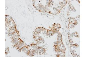 IHC-P Image Immunohistochemical analysis of paraffin-embedded OVCA xenograft, using GPR164, antibody at 1:100 dilution.