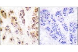 Immunohistochemistry analysis of paraffin-embedded human breast carcinoma, using SSB (Phospho-Ser366) Antibody.