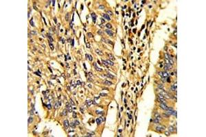 IHC analysis of FFPE human lung carcinoma with HSP60 antibody