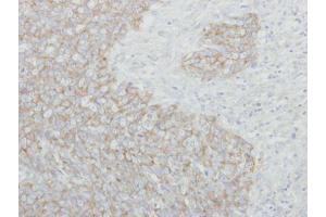 IHC-P Image Immunohistochemical analysis of paraffin-embedded human breast cancer, using NARS, antibody at 1:250 dilution.