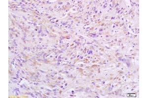 Formalin-fixed and paraffin embedded human cervical carcinoma Rabbit Anti-HSTF2/HSF2 Polyclonal Antibody, Unconjugated (ABIN686137) at 1:200, followed by conjugation to the secondary antibody and DAB staining