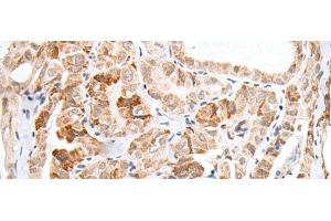 Immunohistochemistry of paraffin-embedded Human thyroid cancer tissue using HOXC11 Polyclonal Antibody at dilution of 1:25(x200)