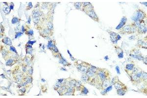 Immunohistochemistry of paraffin-embedded Human mammary cancer using NOD1 Polyclonal Antibody at dilution of 1:100 (40x lens).