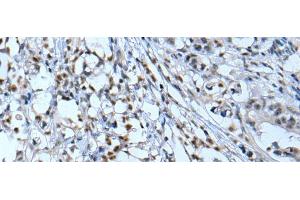 Immunohistochemistry of paraffin-embedded Human gastric cancer tissue using NF1 Polyclonal Antibody at dilution of 1:65(x200)