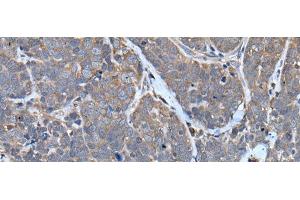 Immunohistochemistry of paraffin-embedded Human thyroid cancer tissue using TNMD Polyclonal Antibody at dilution of 1:40(x200)