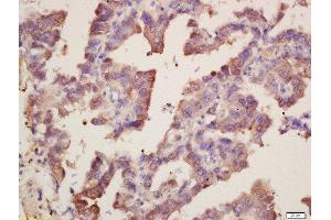 Formalin-fixed and paraffin embedded human lung carcinoma labeled with Rabbit Anti-SOD1 Polyclonal Antibody, Unconjugated  at 1:200 followed by conjugation to the secondary antibody and DAB staining