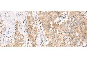 Immunohistochemistry of paraffin-embedded Human esophagus cancer tissue using YRDC Polyclonal Antibody at dilution of 1:30(x200)