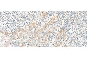 Immunohistochemistry of paraffin-embedded Human tonsil tissue using PSCA Polyclonal Antibody at dilution of 1:25(x200)