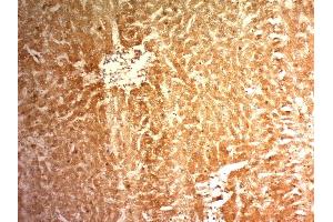 Formalin-fixed, paraffin-embedded human Hepatocellular Carcinoma (HCC) stained with Glypican-3 Monoclonal Antibody (1G12)