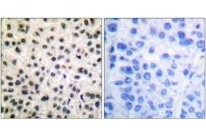 Immunohistochemistry analysis of paraffin-embedded human breast carcinoma, using MEF2A (Phospho-Ser408) Antibody.