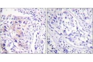Immunohistochemistry analysis of paraffin-embedded human breast carcinoma, using CBL (Phospho-Tyr774) Antibody.