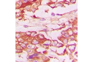 Immunohistochemical analysis of CD120b staining in human lung cancer formalin fixed paraffin embedded tissue section.