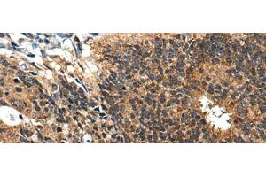Immunohistochemistry of paraffin-embedded Human colorectal cancer tissue using BMPER Polyclonal Antibody at dilution of 1:40(x200)