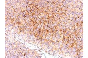 IHC-P Image CXCR5 antibody [C1C2], Internal detects CXCR5 protein at membrane on PC13 xenograft by immunohistochemical analysis.