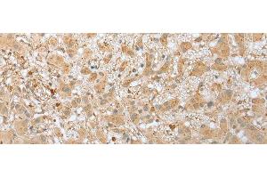 Immunohistochemistry of paraffin-embedded Human liver cancer tissue using FNDC3B Polyclonal Antibody at dilution of 1:45(x200)