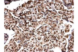 IHC-P Image MTA1 antibody [C1C3] detects MTA1 protein at nucleus on human breast carcinoma by immunohistochemical analysis.