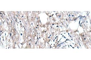 Immunohistochemistry of paraffin-embedded Human gastric cancer tissue using WRN Polyclonal Antibody at dilution of 1:55(x200)