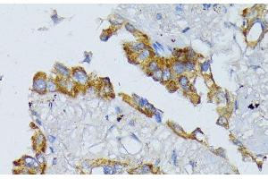 Immunohistochemistry of paraffin-embedded Human lung cancer using ACADL Polyclonal Antibody at dilution of 1:100 (40x lens).