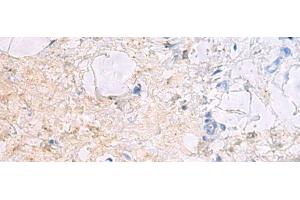 Immunohistochemistry of paraffin-embedded Human gastric cancer tissue using DPCD Polyclonal Antibody at dilution of 1:50(x200)