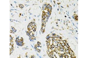 Immunohistochemistry of paraffin-embedded Human esophageal cancer using ADSS Polyclonal Antibody at dilution of 1:100 (40x lens).