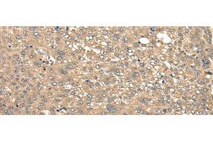 Immunohistochemistry of paraffin-embedded Human liver cancer tissue using CIR1 Polyclonal Antibody at dilution of 1:40(x200)