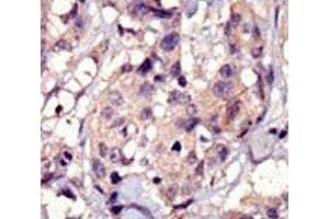 IHC analysis of FFPE human breast carcinoma tissue stained with PDGFRA antibody