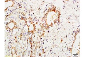 Formalin-fixed and paraffin embedded human breast cancer labeled with Anti-CA153/MUC1/KL-6 Polyclonal Antibody, Unconjugated  at 1:200 followed by conjugation to the secondary antibody and DAB staining.