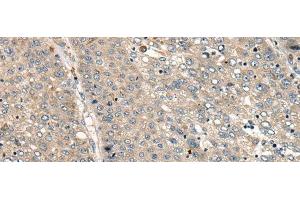 Immunohistochemistry of paraffin-embedded Human liver cancer tissue using CC2D1A Polyclonal Antibody at dilution of 1:35(x200)