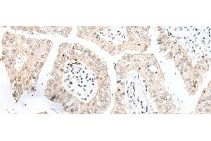 Immunohistochemistry of paraffin-embedded Human liver cancer tissue using NGEF Polyclonal Antibody at dilution of 1:35(x200)