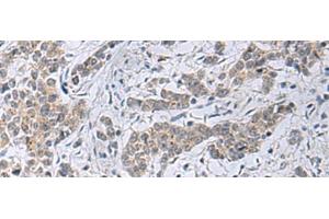 Immunohistochemistry of paraffin-embedded Human colorectal cancer tissue using SLC4A3 Polyclonal Antibody at dilution of 1:35(x200)