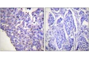 Immunohistochemistry analysis of paraffin-embedded human breast carcinoma, using Caldesmon (Phospho-Ser789) Antibody.