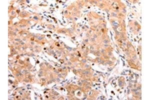 The image on the left is immunohistochemistry of paraffin-embedded Human lung cancer tissue using ABIN7190209(CELSR2 Antibody) at dilution 1/50, on the right is treated with synthetic peptide.
