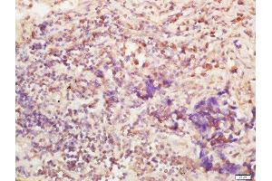 Formalin-fixed and paraffin embedded human lung carcinoma labeled with Anti-BTBD7 Polyclonal Antibody, Unconjugated  at 1:200 followed by conjugation to the secondary antibody and DAB staining