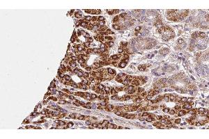 ABIN6272302 at 1/100 staining Human liver cancer tissue by IHC-P.