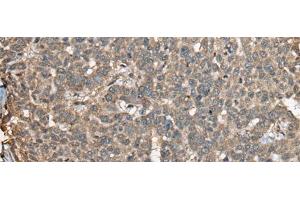 Immunohistochemistry of paraffin-embedded Human liver cancer tissue using COX7A2L Polyclonal Antibody at dilution of 1:30(x200)