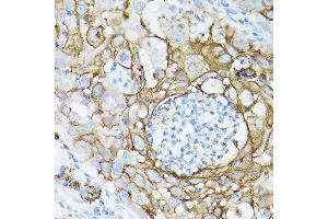 Immunohistochemistry of paraffin-embedded human lung cancer using MUC1 Rabbit mAb (ABIN7268687) at dilution of 1:100 (40x lens).