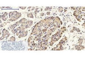 Immunohistochemistry of paraffin-embedded Human stomach cancer tissue using CD284 Polyclonal Antibody at dilution of 1:200.
