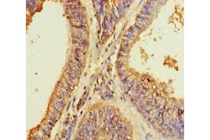 Immunohistochemistry of paraffin-embedded human endometrial cancer using ABIN7164469 at dilution of 1:100