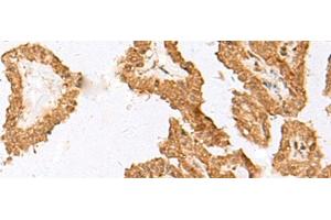 Immunohistochemistry of paraffin-embedded Human thyroid cancer tissue using FAM84A Polyclonal Antibody at dilution of 1:35(x200)